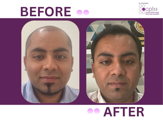 Hair transplant result