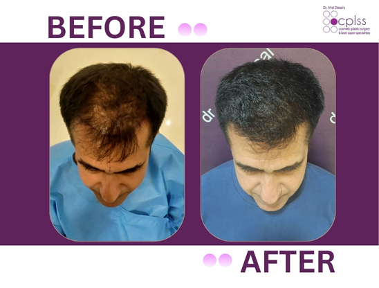 Hair transplant result