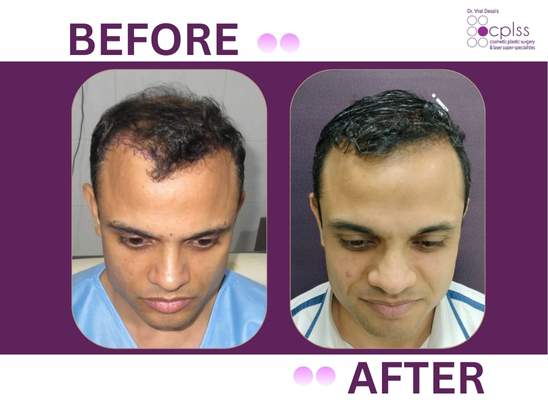 Hair transplant result