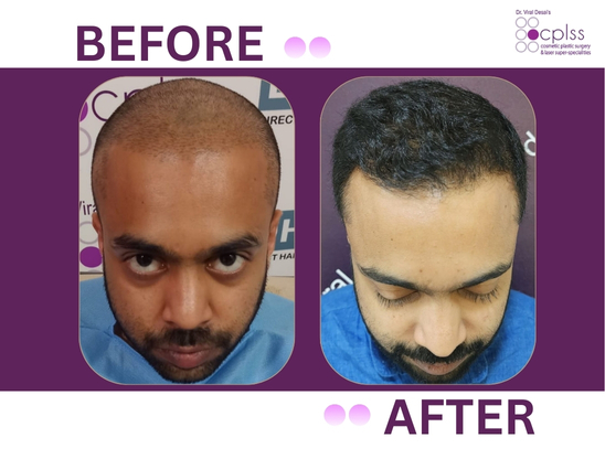 Hair transplant result