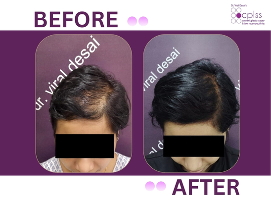 Hair transplant result