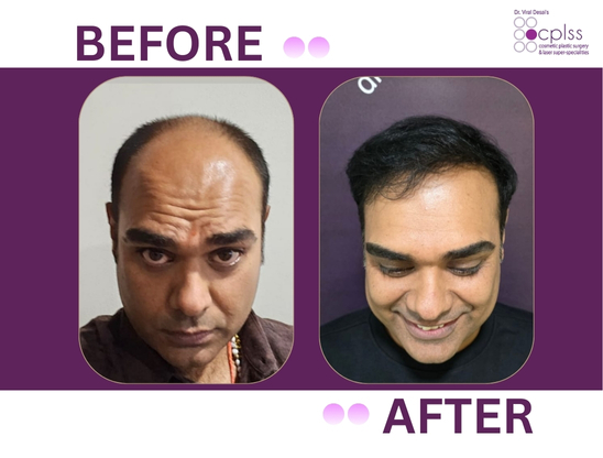 Hair transplant result